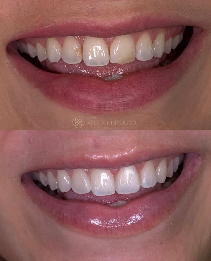 Antes e depois - facetas em resina, caso 1