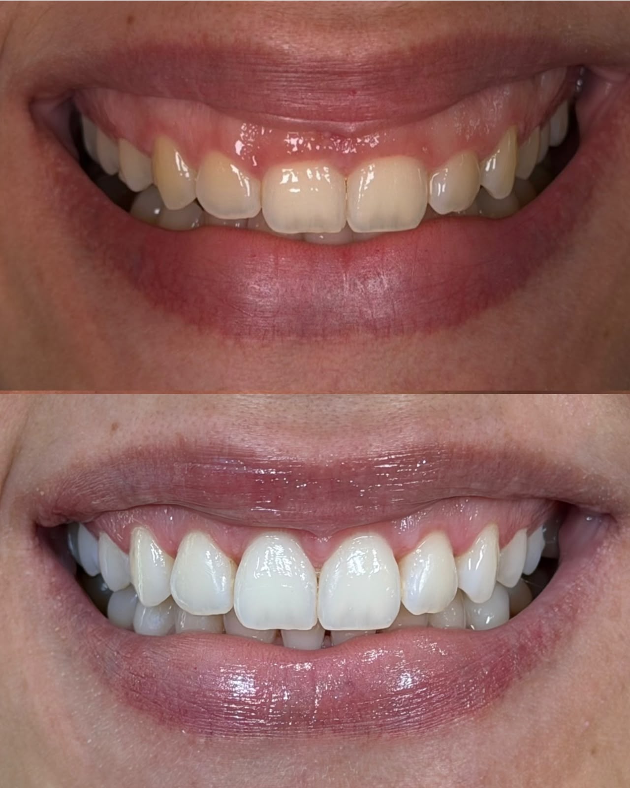 Antes e depois - facetas em resina, caso 2