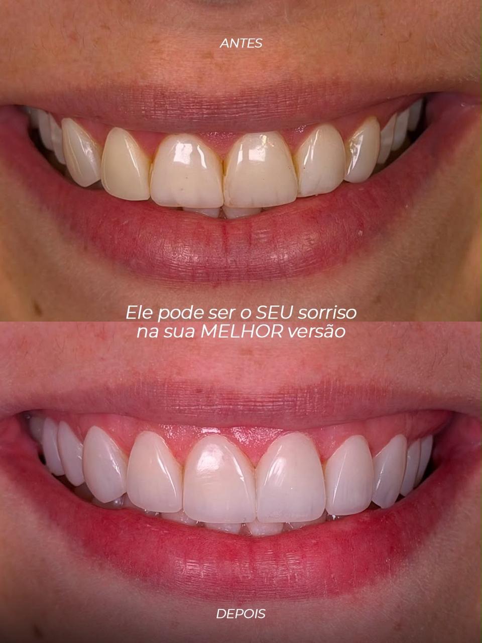 Antes e depois - facetas em resina, caso 3