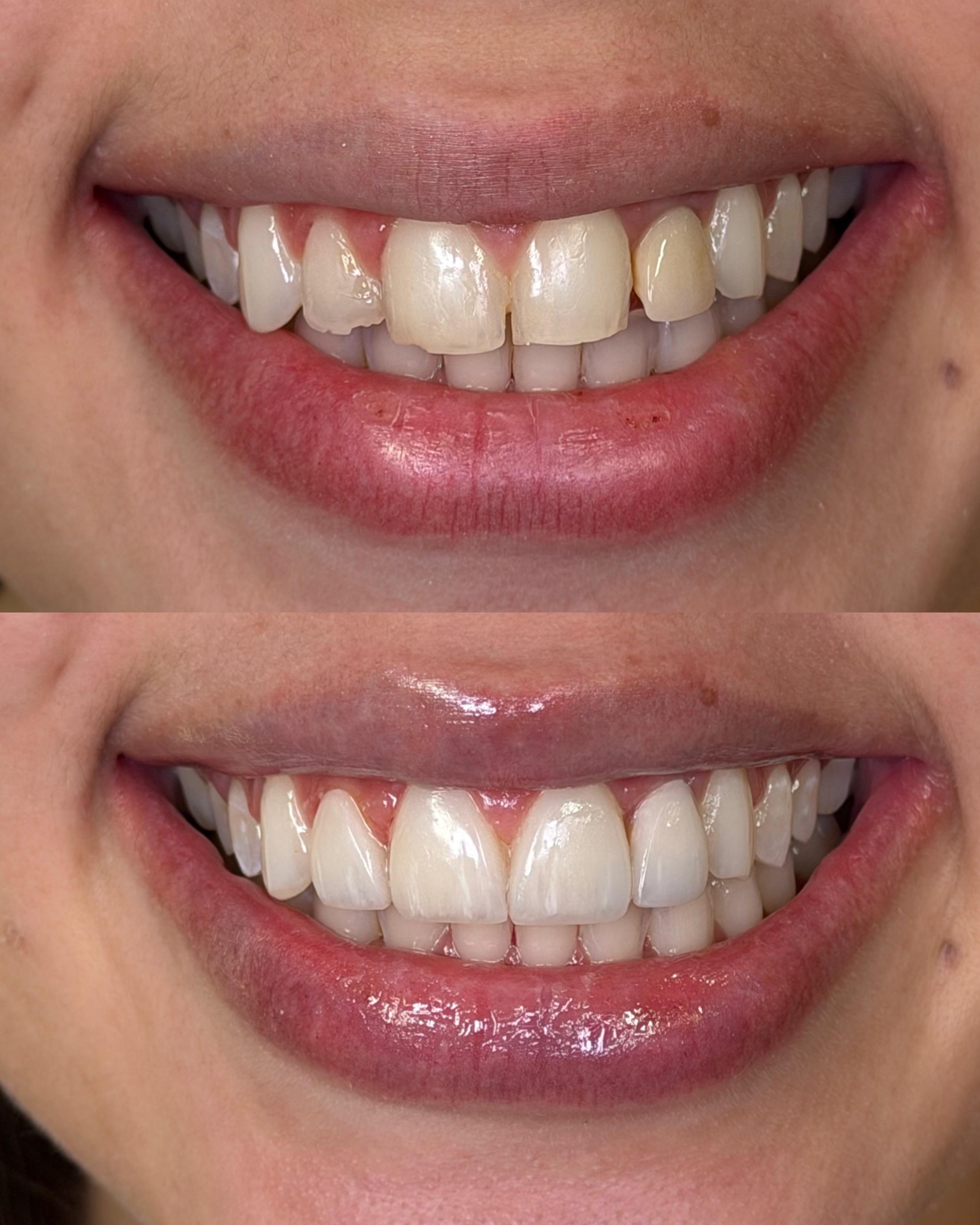 Antes e depois - facetas em resina, caso 4