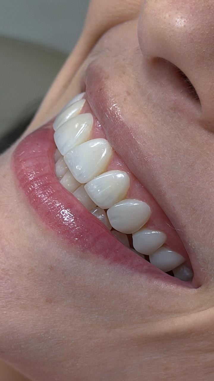 Antes e depois - facetas em resina, caso 5