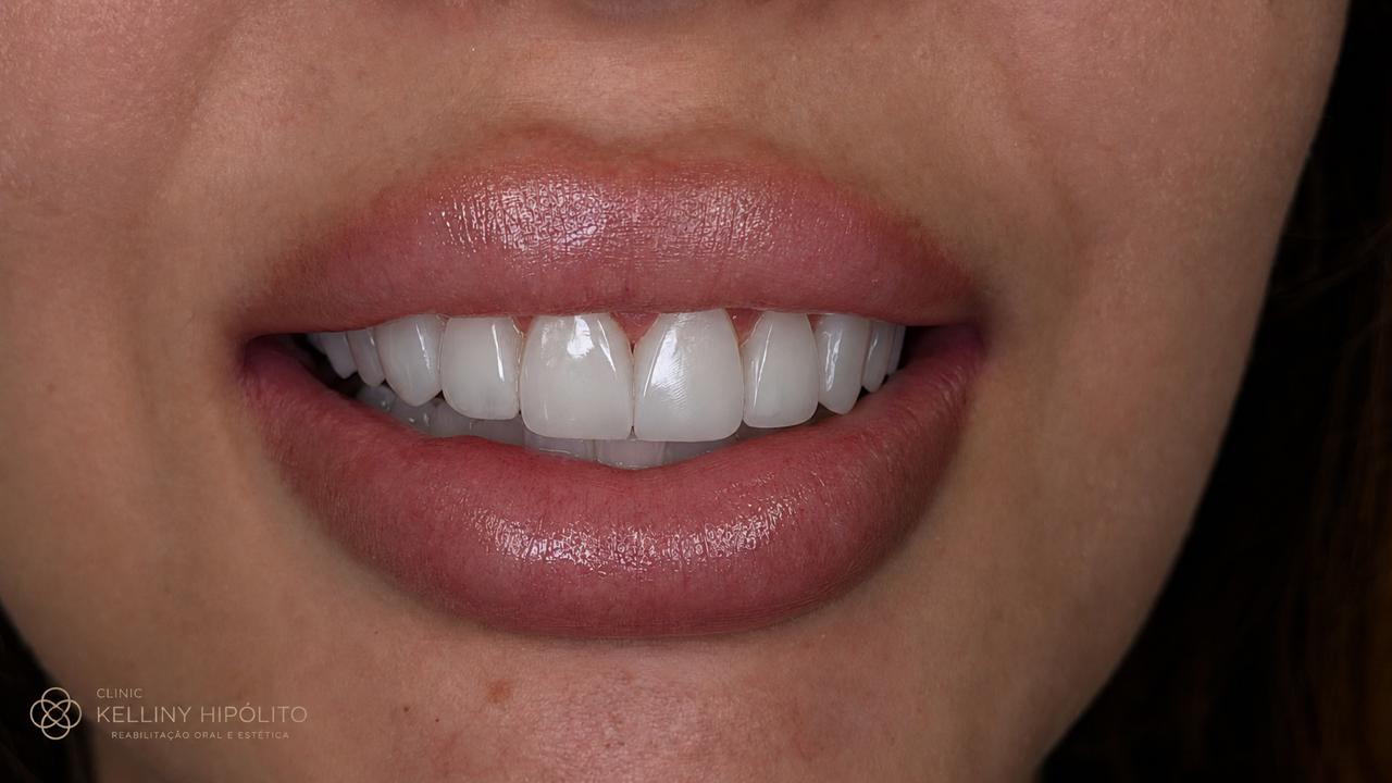 Antes e depois - facetas em resina, caso 6